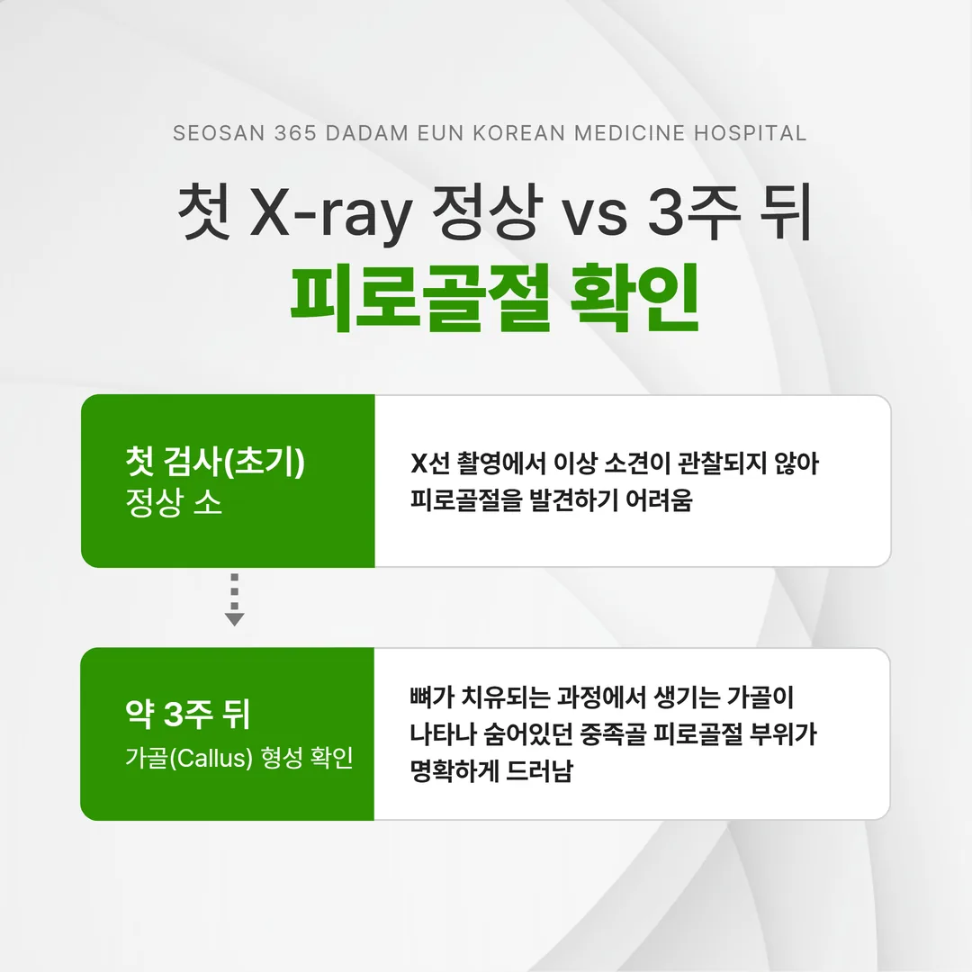 첫 X선 정상 소견과 3주 뒤 가골이 나타난 피로골절 비교