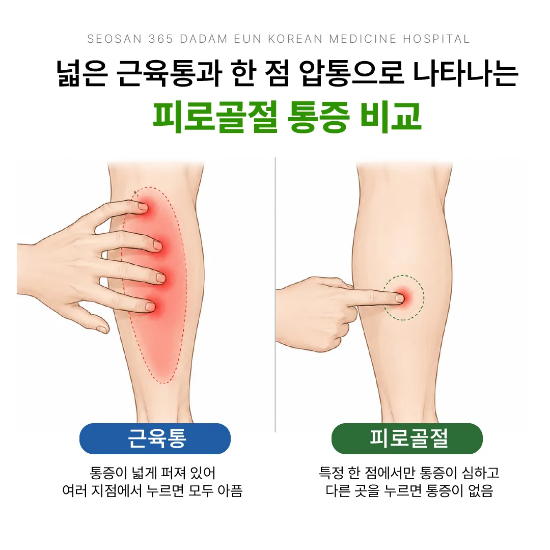 넓은 근육통과 한 점 압통으로 나타나는 피로골절 통증 비교