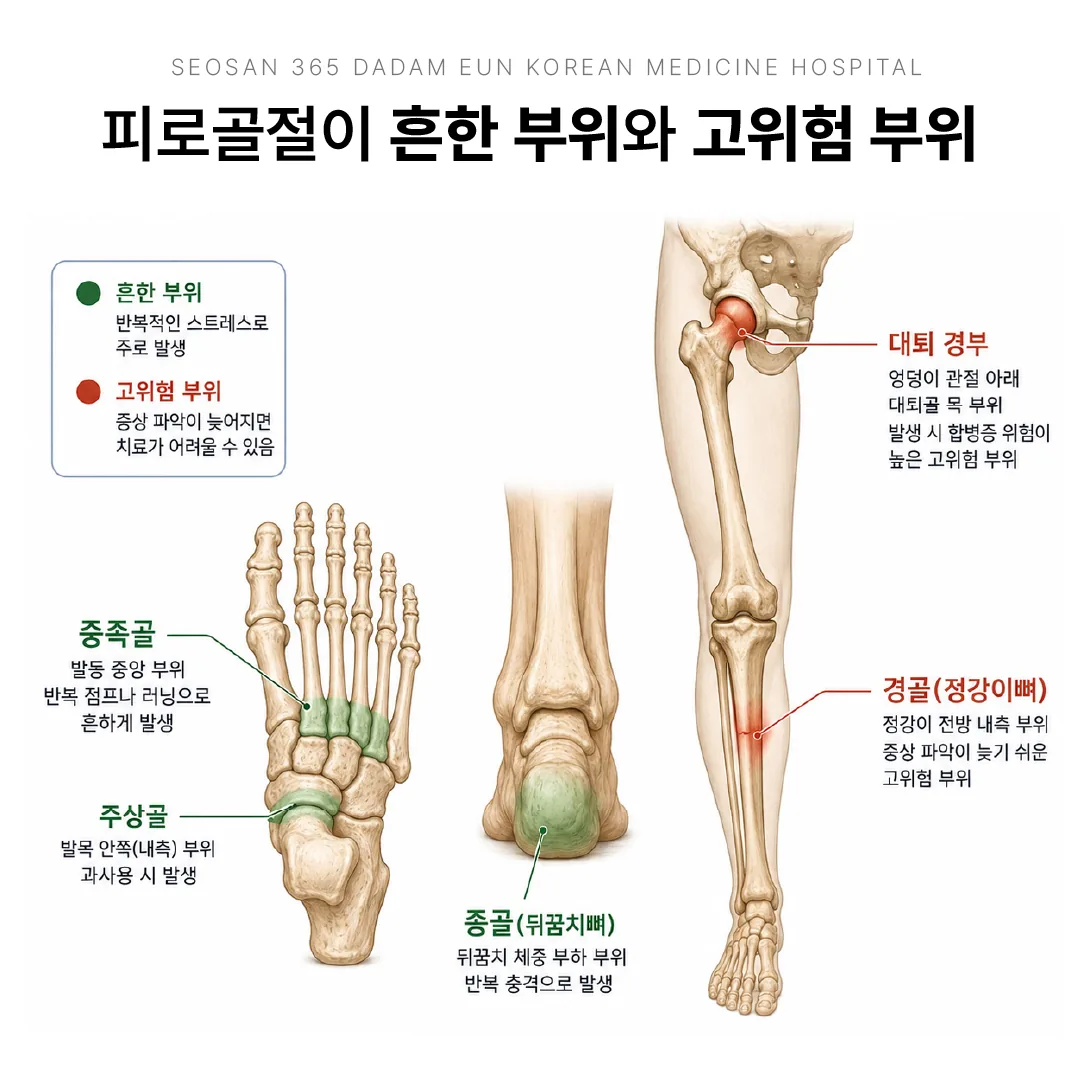 중족골 종골 경골 주상골 대퇴 경부 피로골절 부위 도해