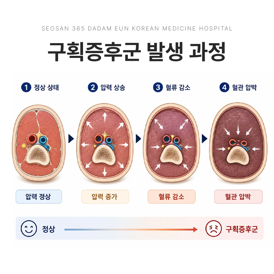 구획증후군에서 근막 안쪽 압력이 올라가 혈관을 압박하는 과정 도해