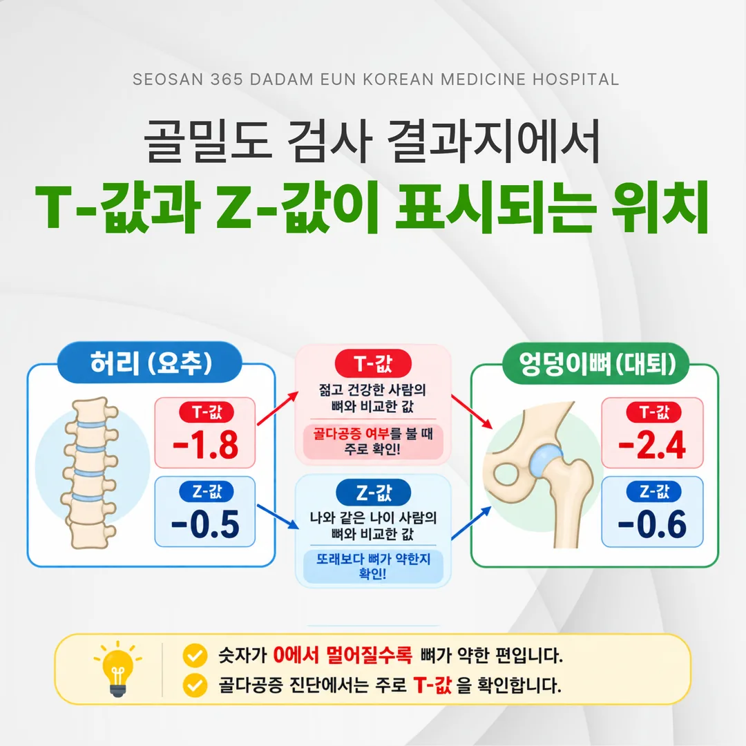 골밀도 검사 결과지에서 T-값과 Z-값이 표시되는 위치를 설명한 도해
