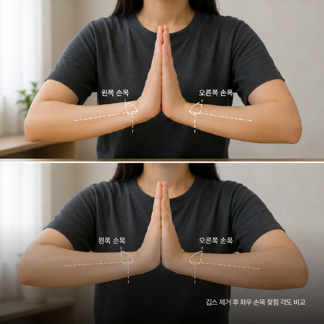 깁스 제거 후 좌우 손목 젖힘 각도 비교