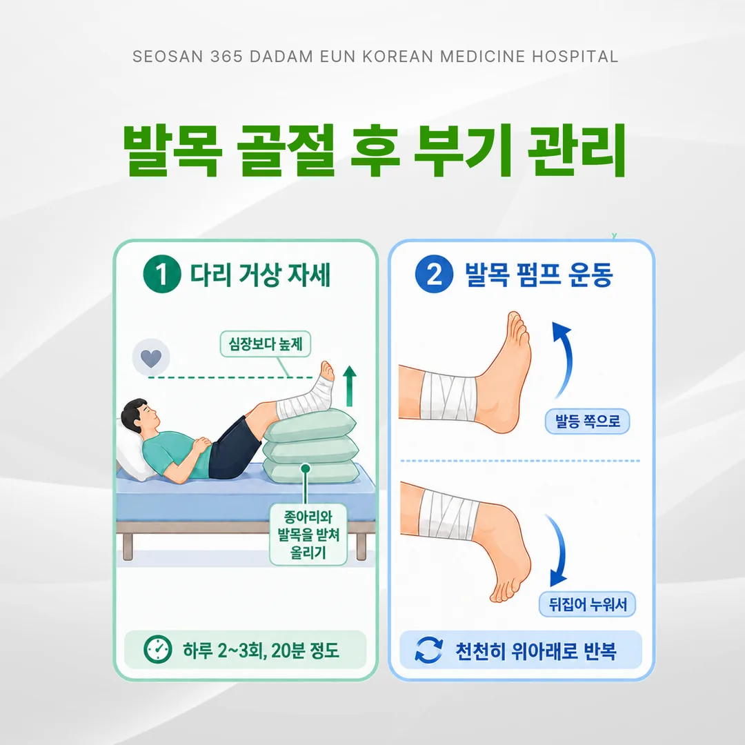 발목 골절 후 부기 관리를 위한 다리 거상 자세와 발목 펌프 운동 그림