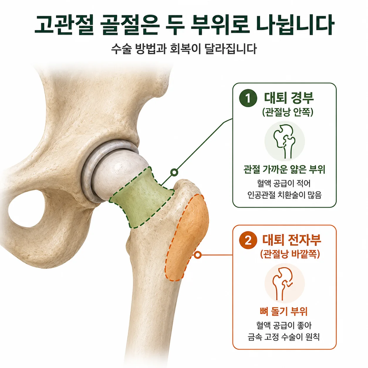 고관절 골절이 생기는 대퇴 경부와 대퇴 전자부 위치를 표시한 그림