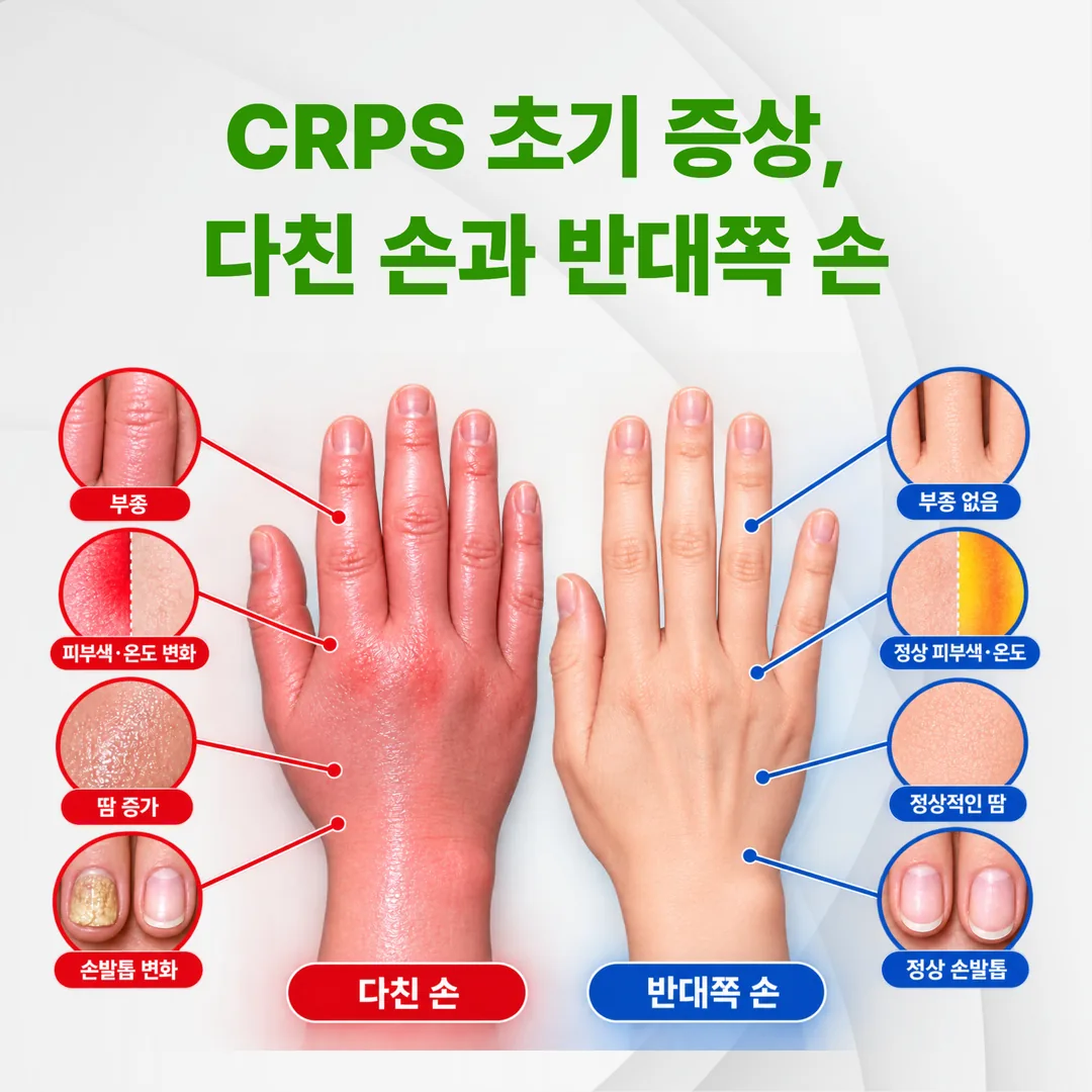 복합부위통증증후군 초기 증상 좌우 비교 관찰