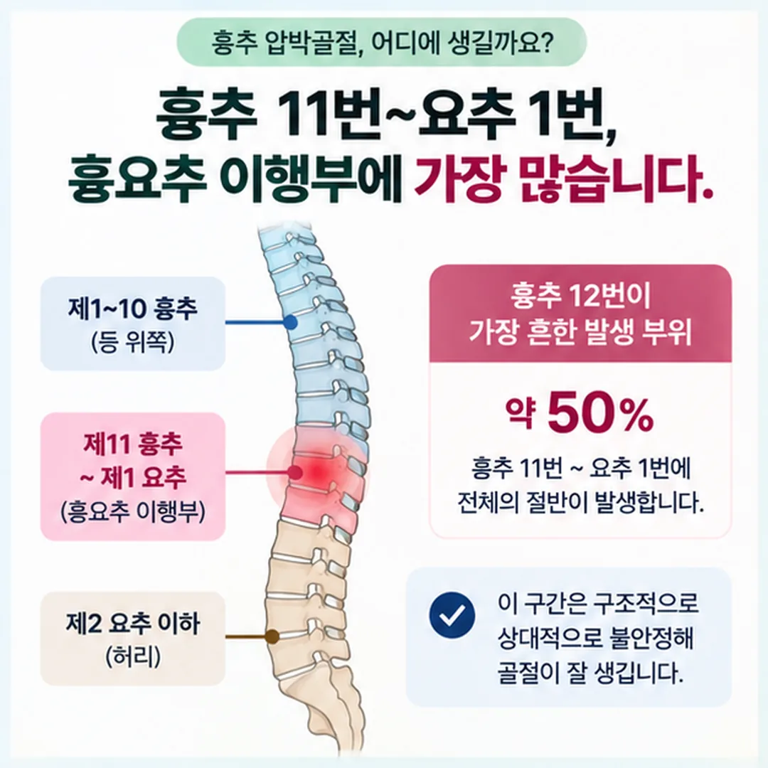 등뼈와 허리뼈를 세 구간으로 나누고 흉요추 이행부에 압박골절이 몰리는 것을 표시한 개념도