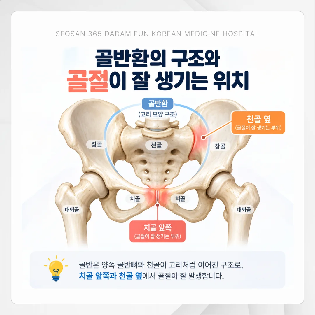 골반환 구조와 골절이 잘 생기는 위치를 표시한 그림