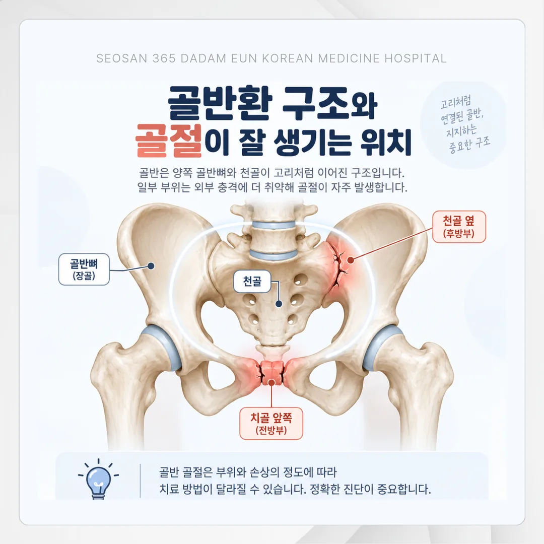 골반 골절 안정형과 불안정형을 가르는 세 가지 기준 도표