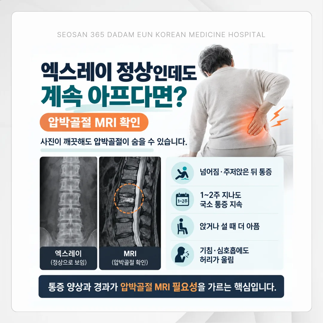 척추 앞기둥이 눌려 내려앉은 압박골절의 구조 개념도