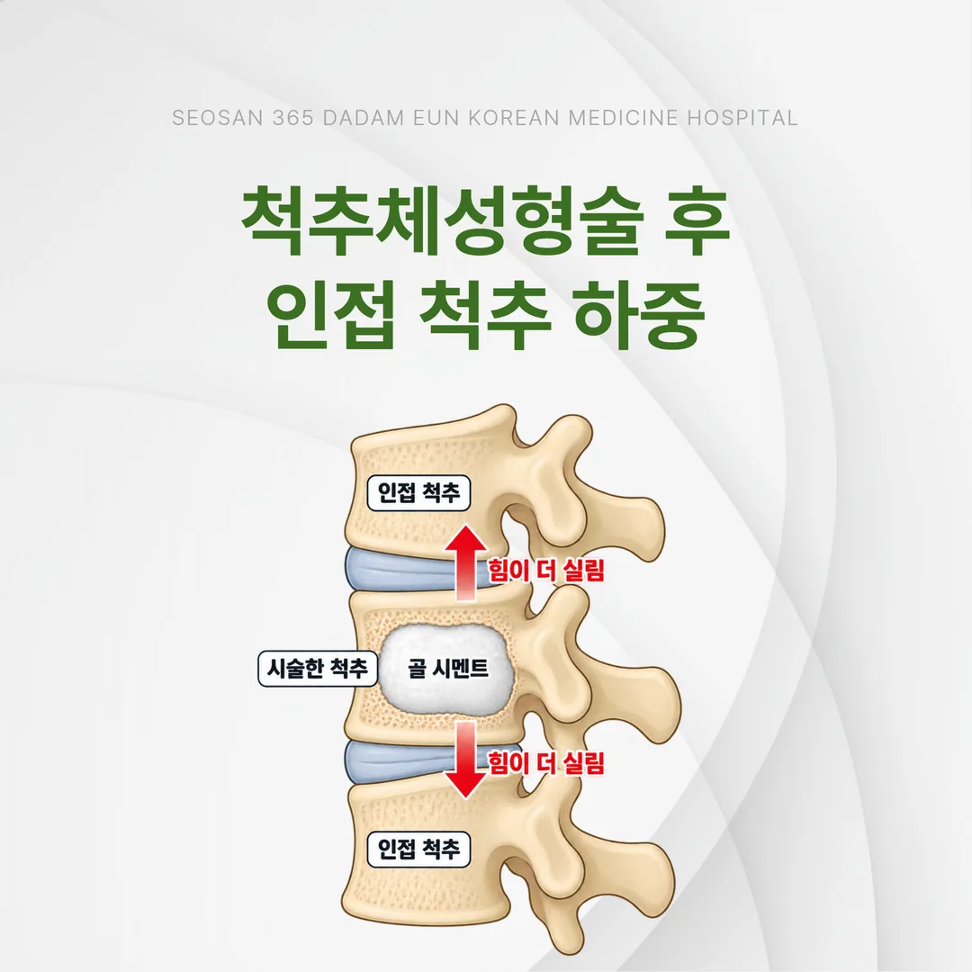 척추체성형술 후 인접 척추에 하중이 실리는 관계 개념도