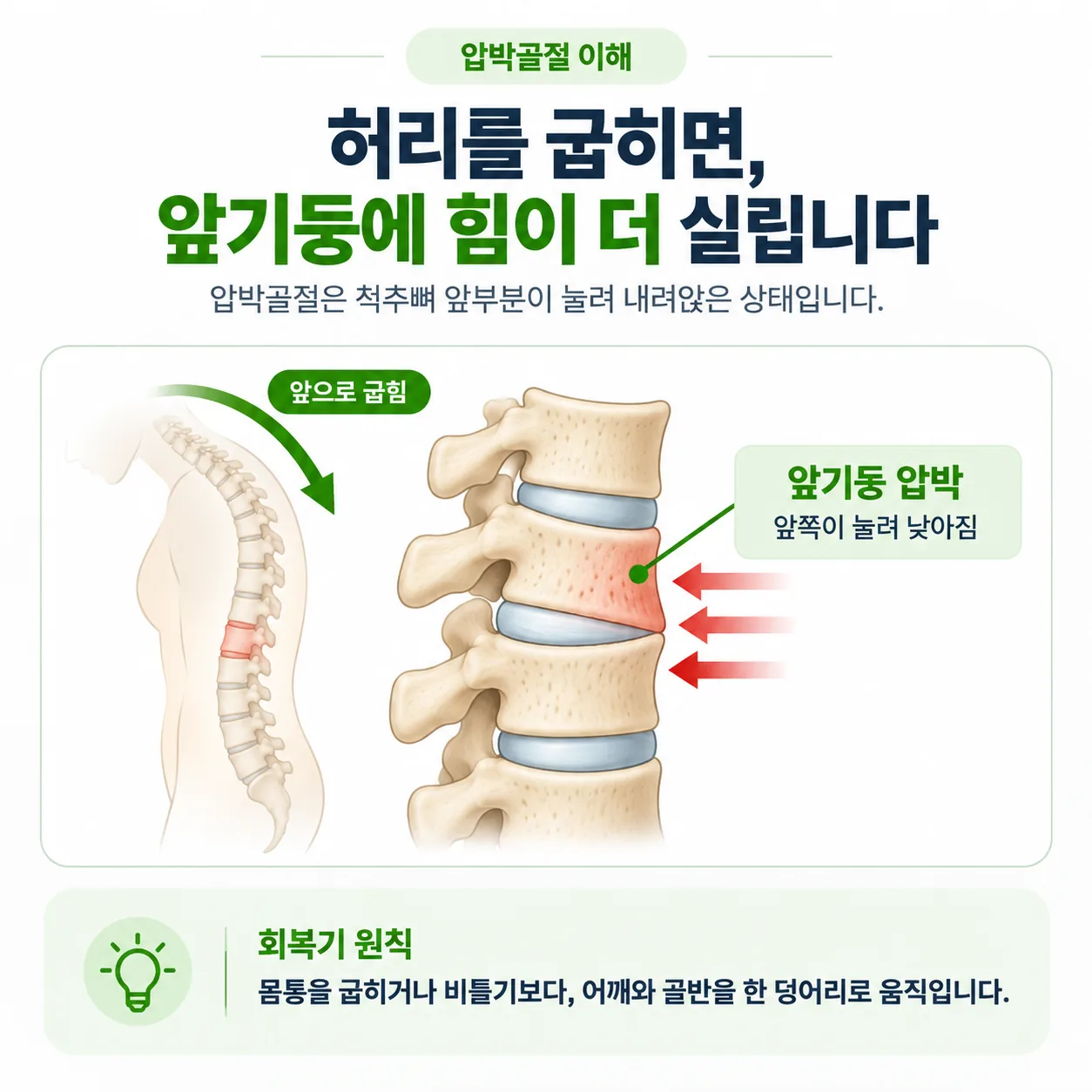 압박골절이 생긴 척추뼈 앞기둥과 허리를 굽힐 때 힘이 실리는 방향을 나타낸 개념도