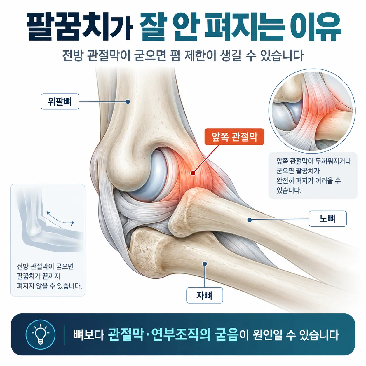 팔꿈치 관절을 이루는 세 뼈와 앞쪽 관절막 위치를 표시한 해부 도해
