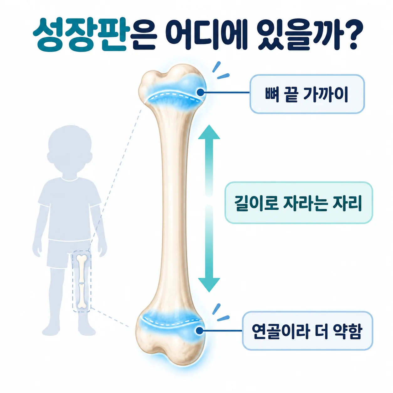 아이 긴 뼈 끝에 있는 성장판(골단판)의 위치를 표시한 도식
