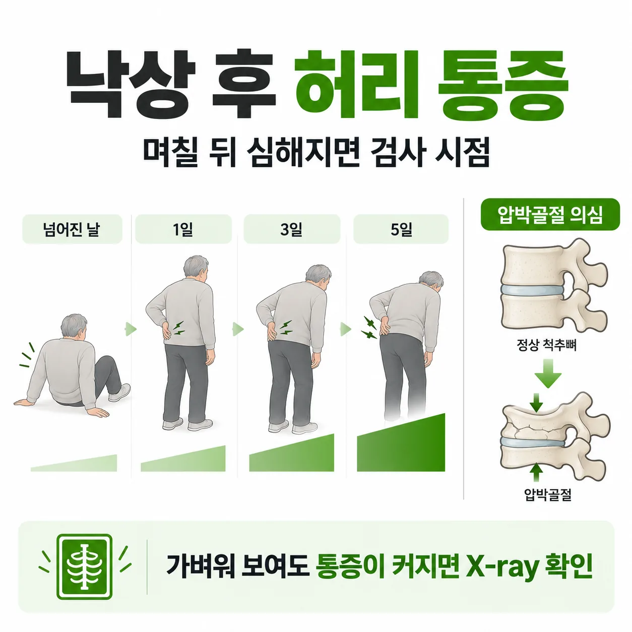 낙상 뒤 며칠 사이 커지는 허리 통증과 눌려 납작해진 척추뼈를 함께 보여 주는 대표 개념도