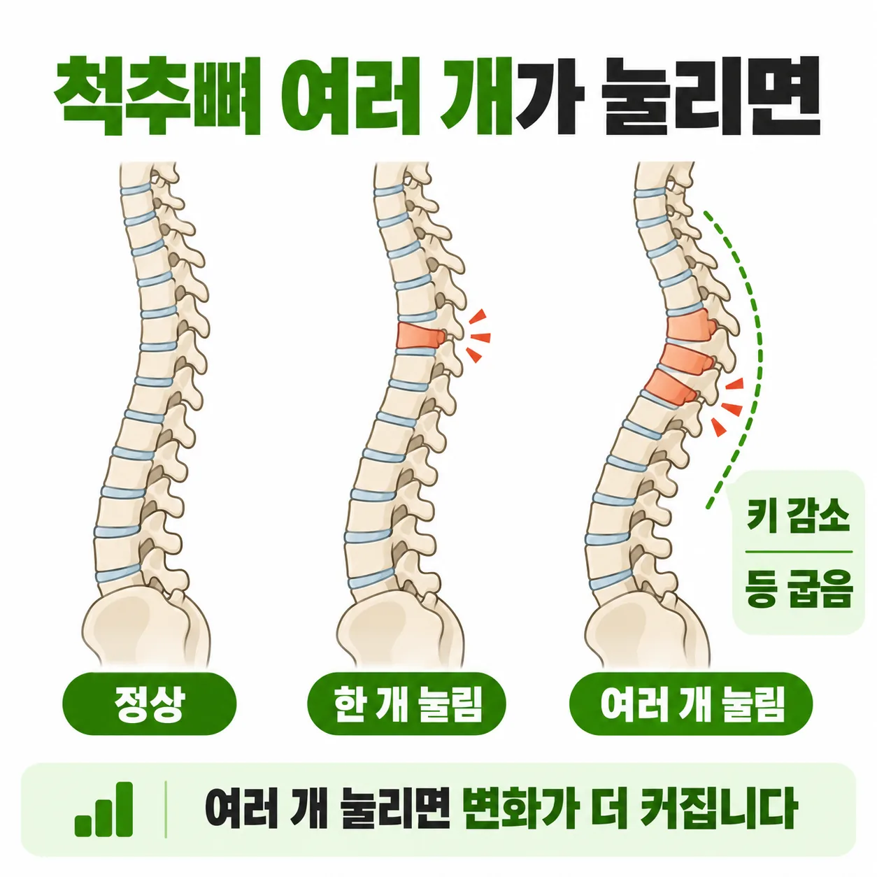 척추뼈 여러 개가 쐐기 모양으로 눌리며 등이 굽고 키가 줄어드는 과정 개념도