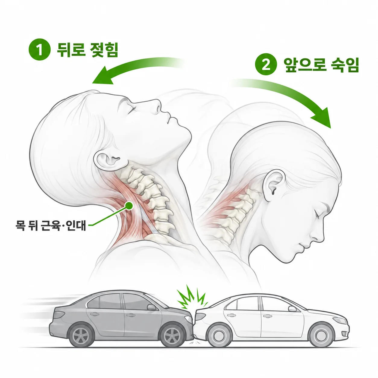 뒤에서 받힐 때 목이 뒤로 젖혀졌다가 앞으로 숙여지는 편타성 손상 개념도