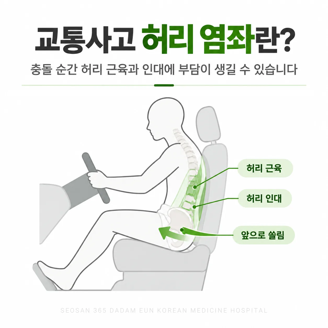 교통사고 충돌 순간 허리 근육과 인대에 힘이 실리는 방향을 보여 주는 허리 염좌 개념도
